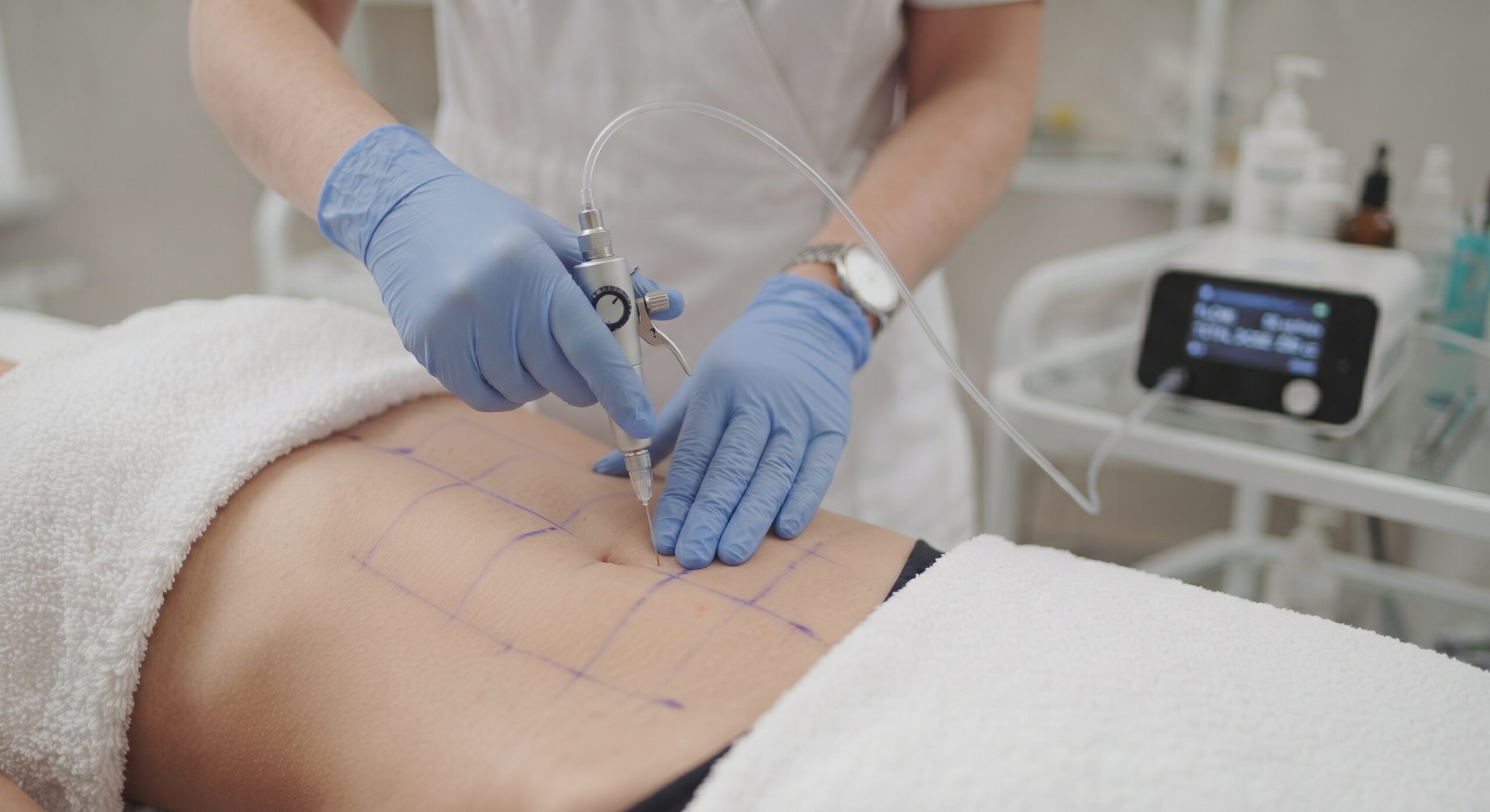 Carboxiterapia en El Albir: aplicación de CO₂ médico en abdomen en Alta Armonía