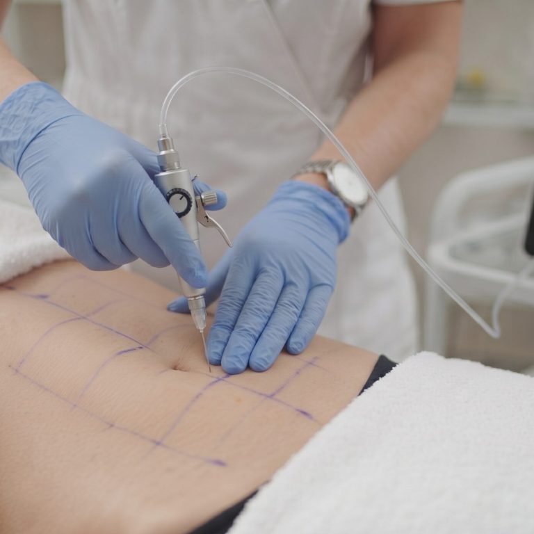 Carboxiterapia en El Albir: aplicación de CO₂ médico en abdomen en Alta Armonía